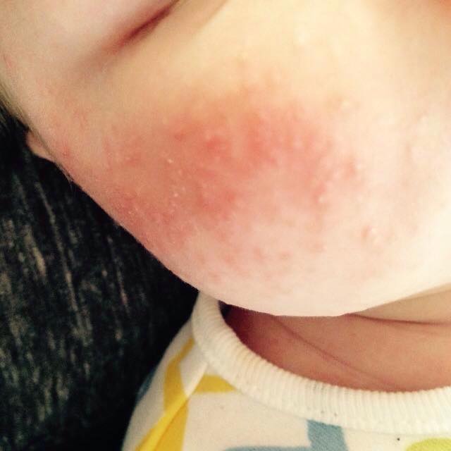 Baby acne 1 